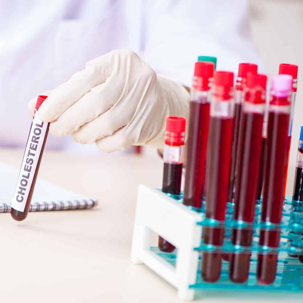 Kādi holesterīna rādītāji ir jāzina?